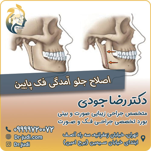 اصلاح جلو آمدگی فک پایین