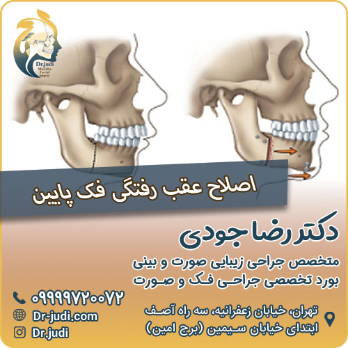 اصلاح عقب رفتگی فک پایین