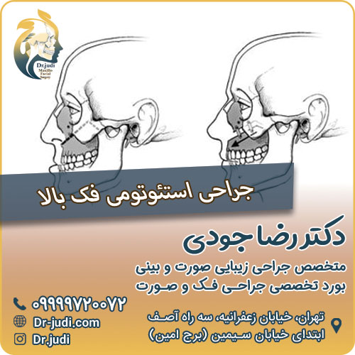جراحی استئوتومی فک بالا
