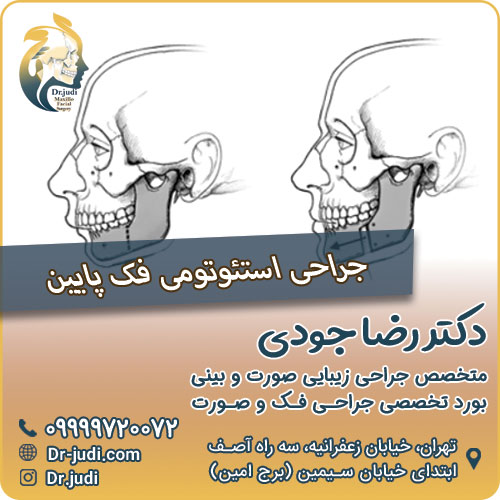 جراحی استئوتومی فک پایین