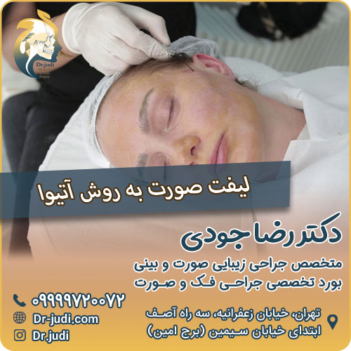 لیفت صورت به روش آتیوا