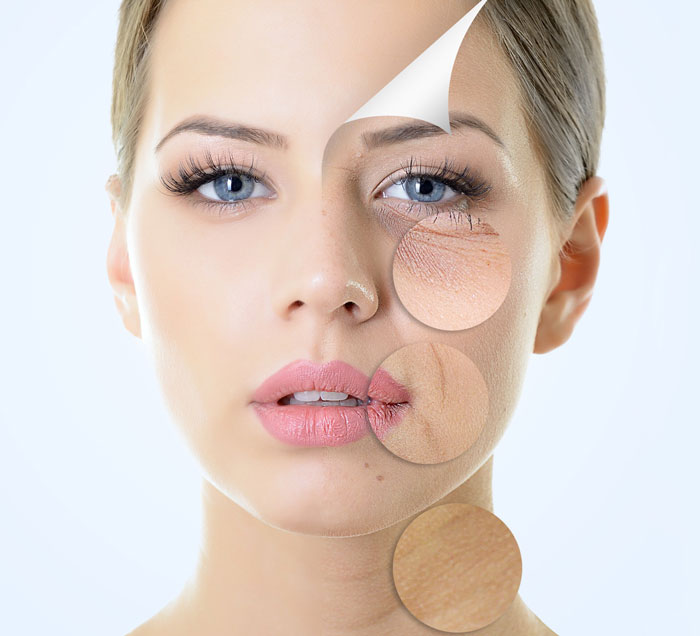 مزوتراپی جهت رفع چروک و تیرگی دور چشم