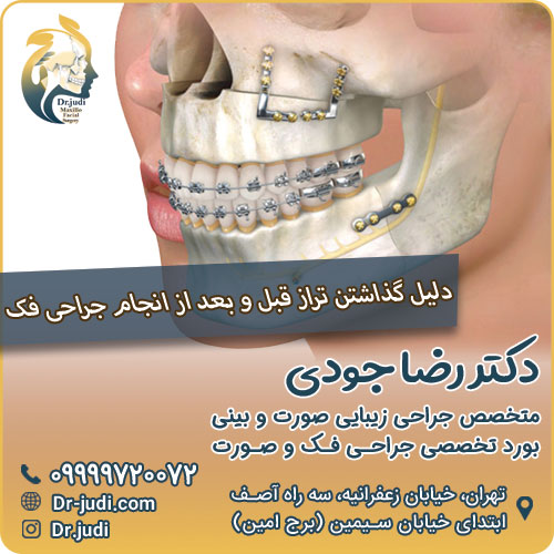 دلیل گذاشتن تراز قبل و بعد از انجام جراحی فک